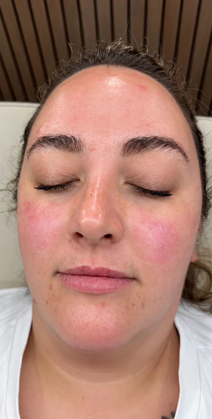After: Client before and after a dermaplane and facial