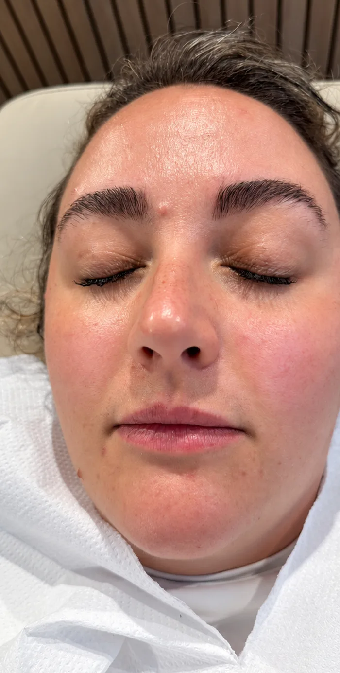 Before: Client before and after a dermaplane and facial