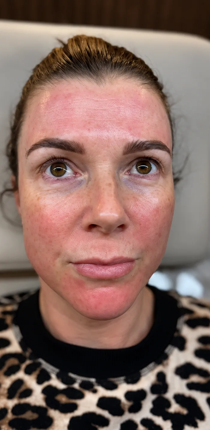 After: Client before and after a Full Seasons Glow Facial with BioReal Peel and microneedling