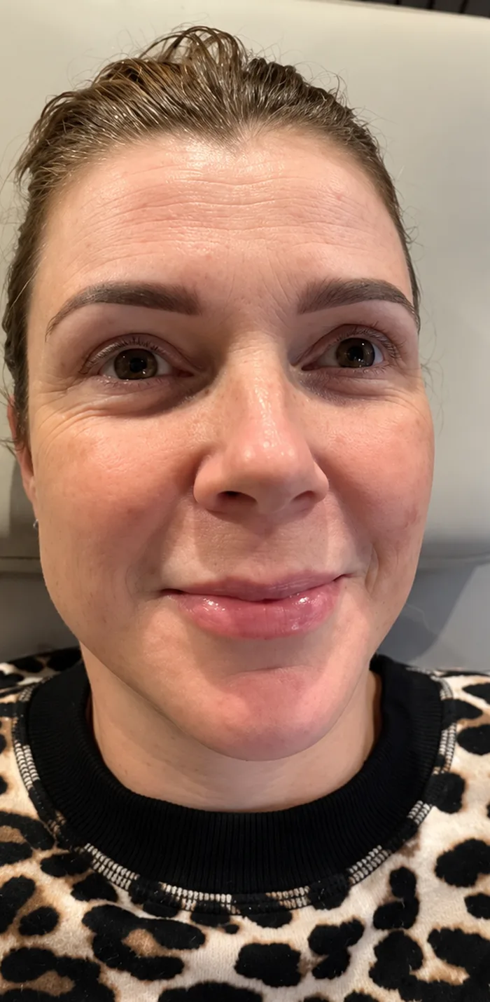 Before: Client before and after a Full Seasons Glow Facial with BioReal Peel and microneedling