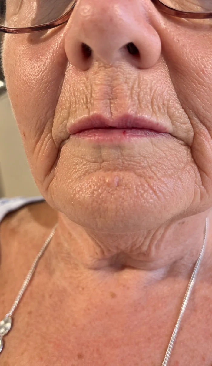 After: Client before and after lip enhancement