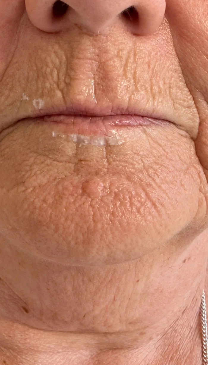 Before: Client before and after lip enhancement