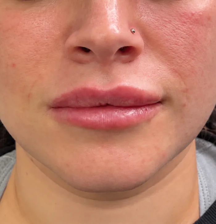After: Client before and after nasal fold filler and lip enhancement