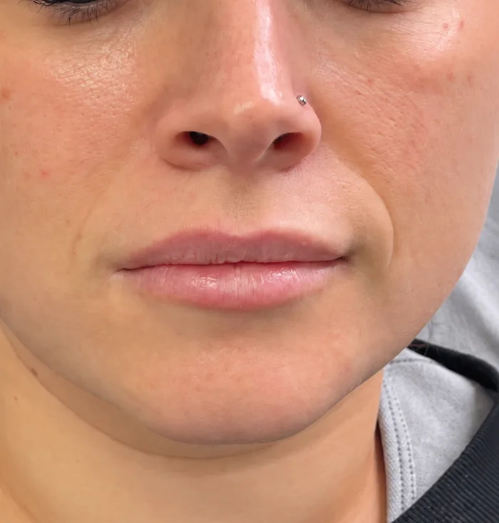 Before: Client before and after nasal fold filler and lip enhancement